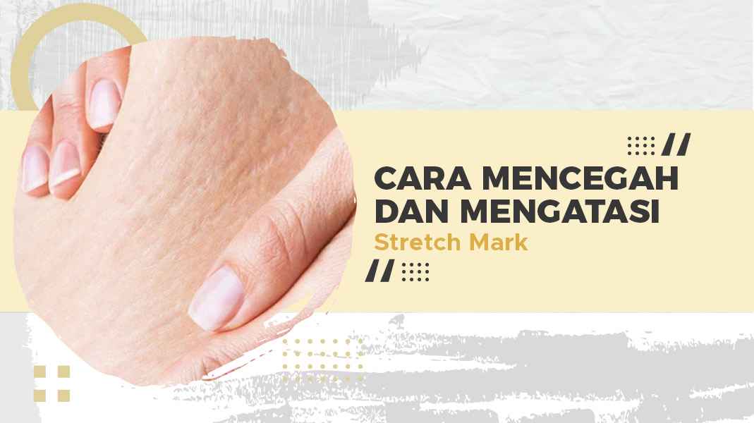 Apa Stretch Mark dan Cara Menghilangkannya